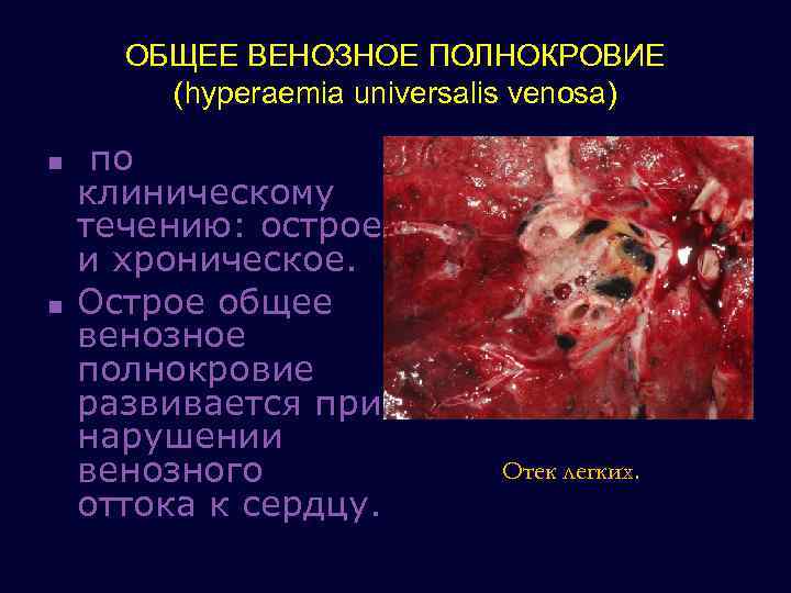 ОБЩЕЕ ВЕНОЗНОЕ ПОЛНОКРОВИЕ (hyperaemia universalis venosa) n n по клиническому течению: острое и хроническое.