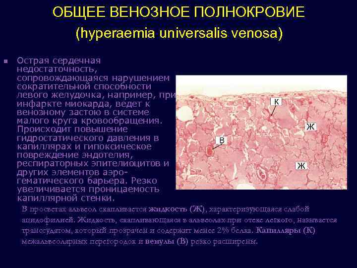 Венозное полнокровие развивается при