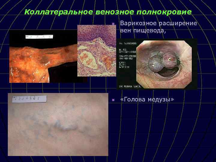 Коллатеральное венозное полнокровие n n Варикозное расширение вен пищевода, «Голова медузы» 