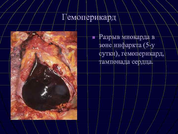 Гемоперикард n Разрыв миокарда в зоне инфаркта (5 -у сутки), гемоперикард, тампонада сердца. 