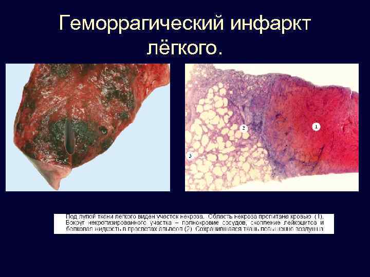 Геморрагический инфаркт лёгкого. 