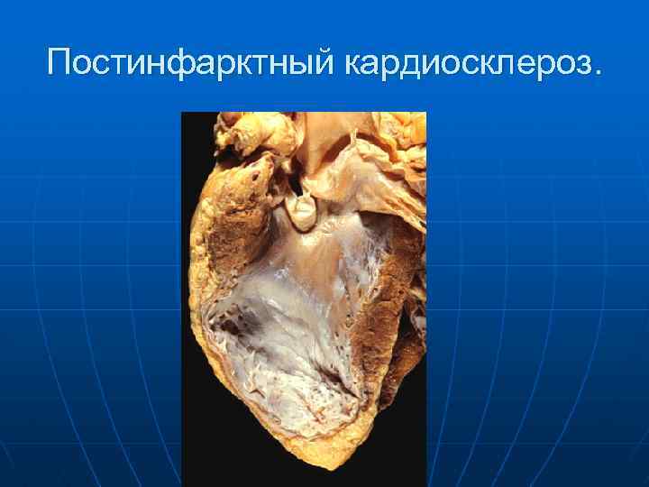 Постинфарктный кардиосклероз. 