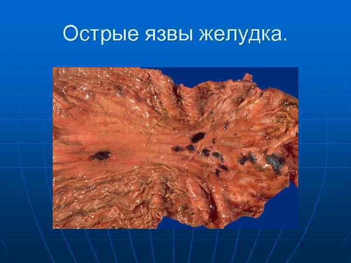 Острые язвы желудка. 