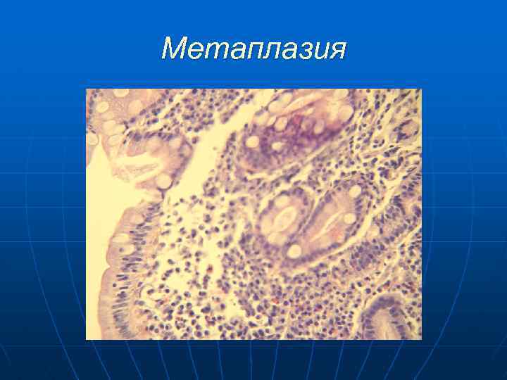 Метаплазия 