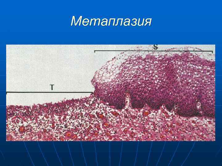 Метаплазия 