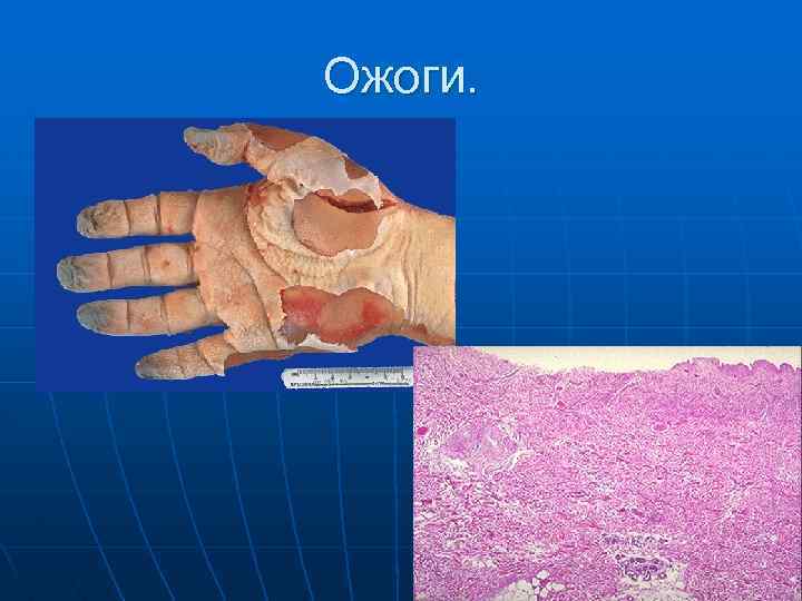 Ожоги. 