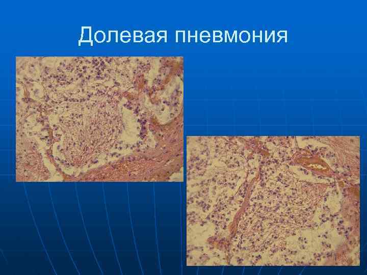 Долевая пневмония 