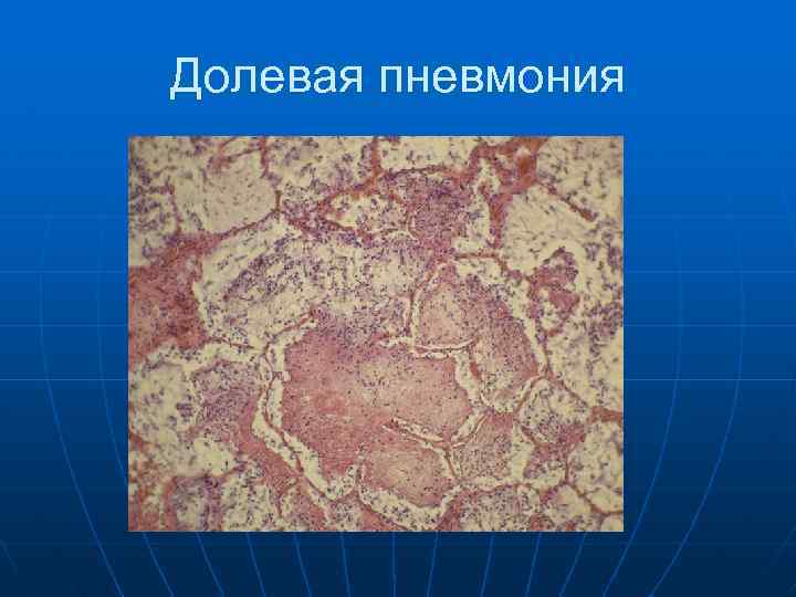 Долевая пневмония 