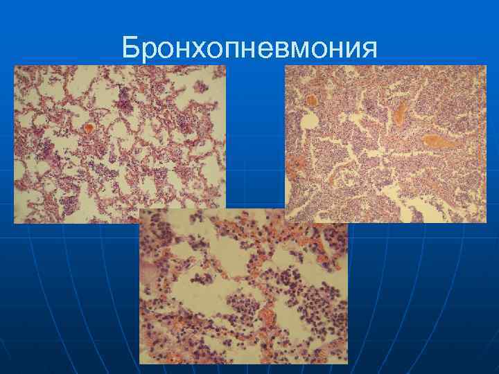 Бронхопневмония 