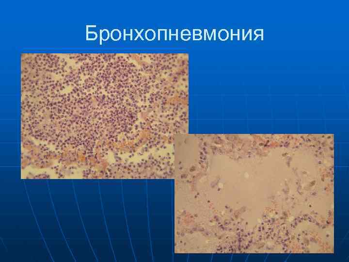 Бронхопневмония 