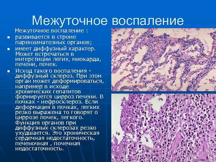 Межуточное воспаление n n n Межуточное воспаление : развивается в строме паренхиматозных органов; имеет