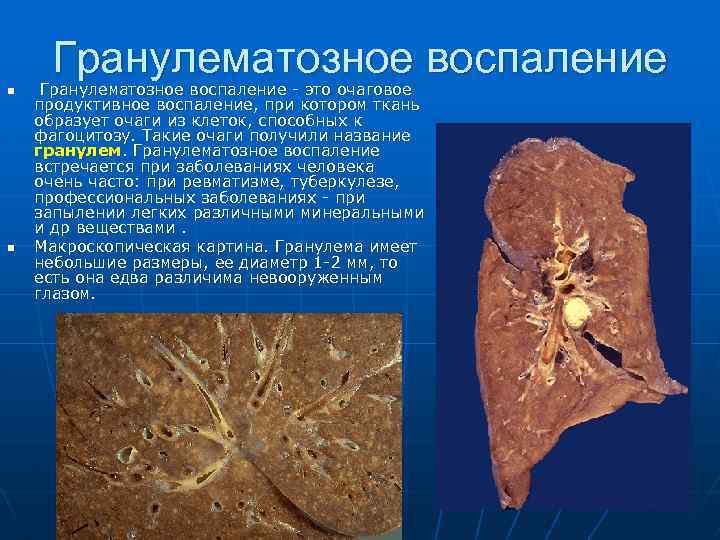 Гранулематозное воспаление n n Гранулематозное воспаление - это очаговое продуктивное воспаление, при котором ткань
