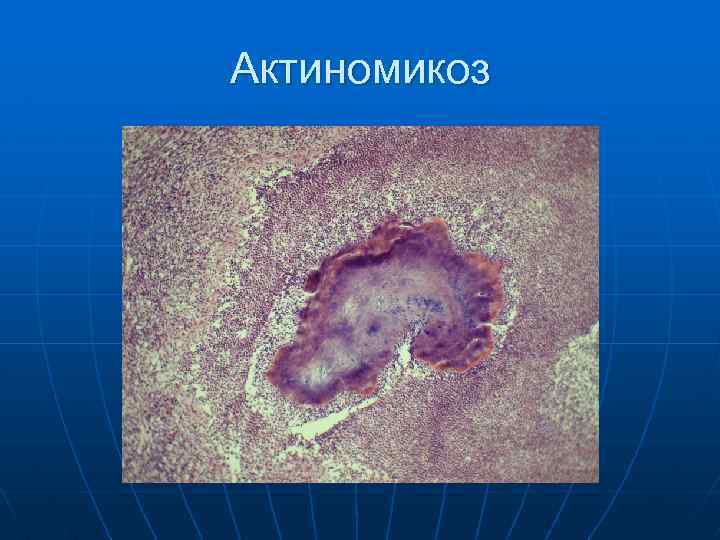 Актиномикоз 