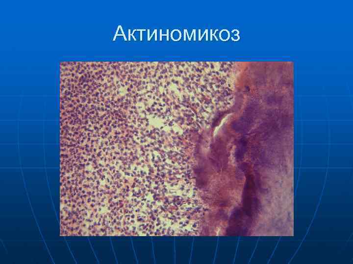 Актиномикоз 