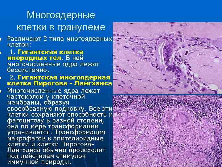 n n Многоядерные клетки в гранулеме Различают 2 типа многоядерных клеток: 1. Гигантская клетка