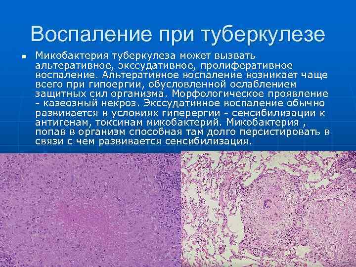 Воспаление при туберкулезе n Микобактерия туберкулеза может вызвать альтеративное, экссудативное, пролиферативное воспаление. Альтеративное воспаление