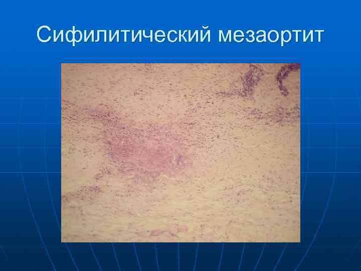 Сифилитический мезаортит 