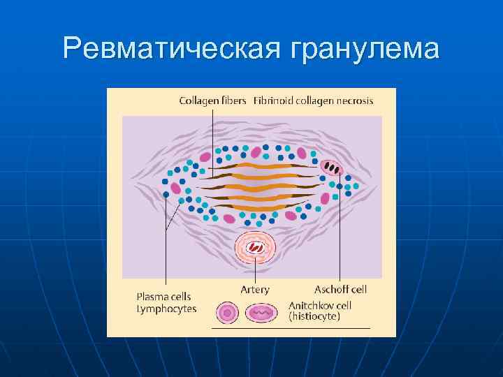 Ревматическая гранулема 