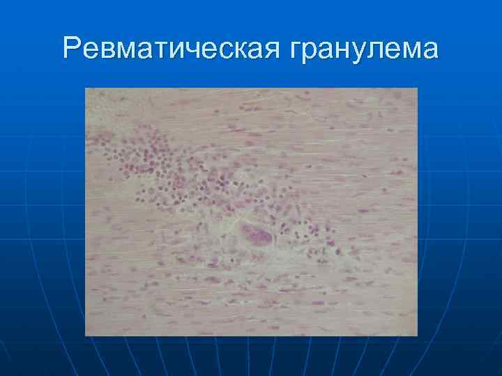 Ревматическая гранулема 