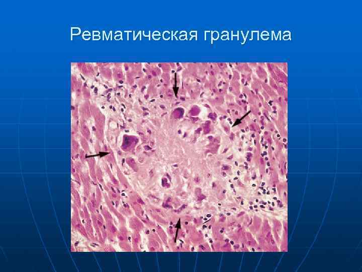 Ревматическая гранулема 