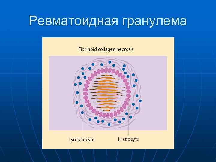 Ревматоидная гранулема 