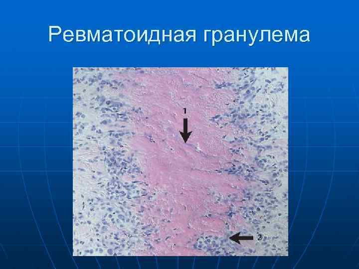Ревматоидная гранулема 