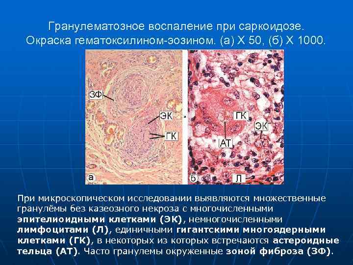 Гранулематозное воспаление при саркоидозе. Окраска гематоксилином-эозином. (а) Х 50, (б) Х 1000. При микроскопическом