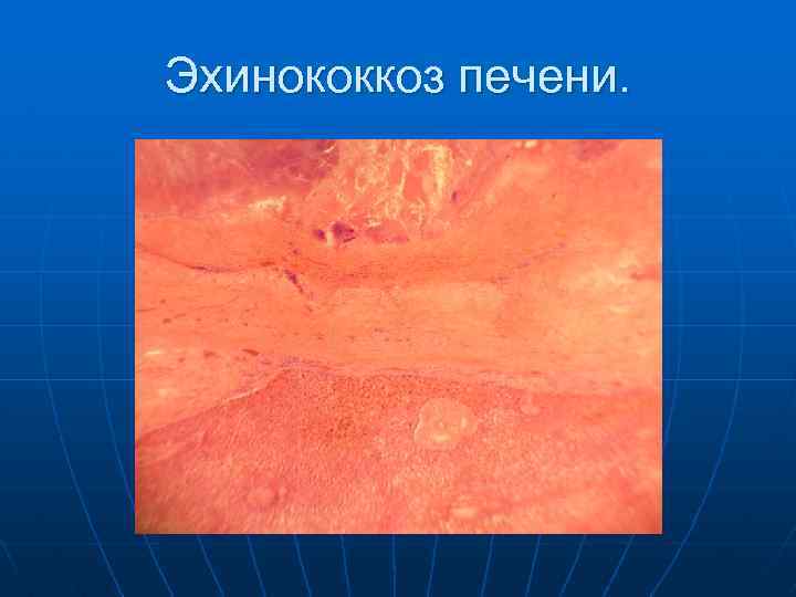 Эхинококкоз печени. 