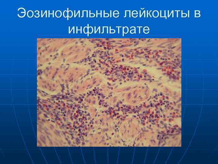 Эозинофильные лейкоциты в инфильтрате 
