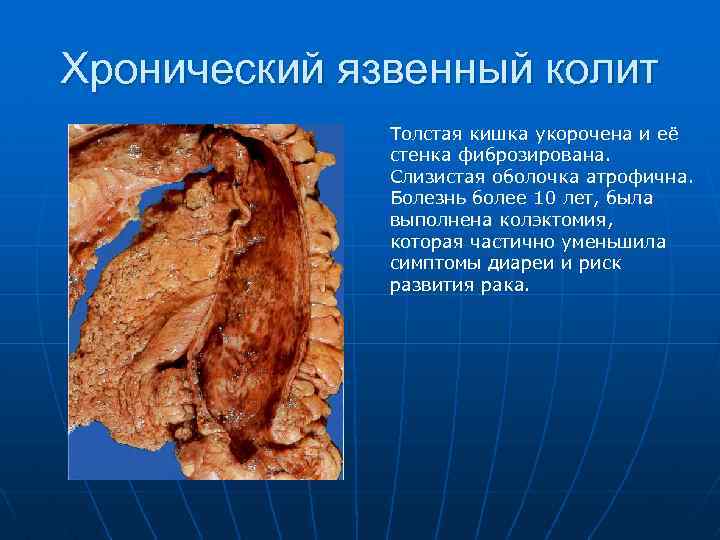 Хронический язвенный колит Толстая кишка укорочена и её стенка фиброзирована. Слизистая оболочка атрофична. Болезнь