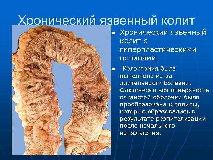 Хронический язвенный колит n n Хронический язвенный колит с гиперпластическими полипами. Колэктомия была выполнена