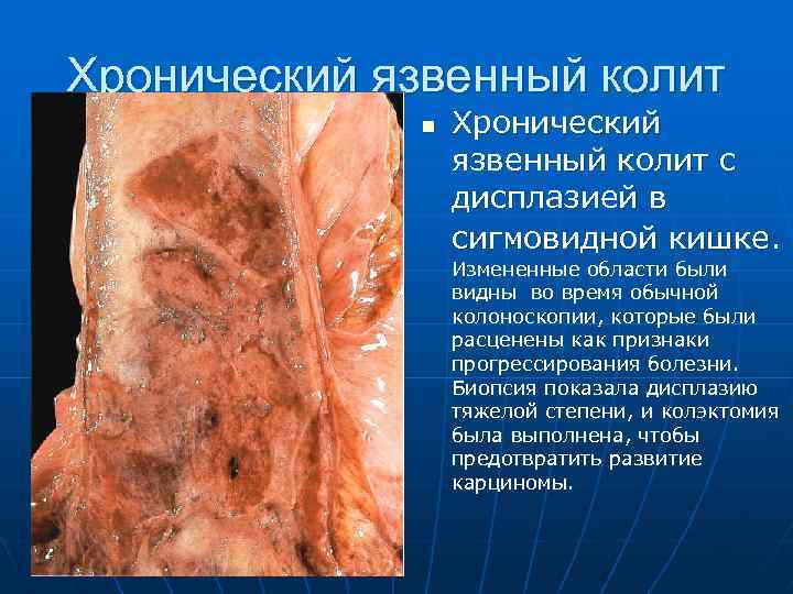 Хронический язвенный колит n Хронический язвенный колит с дисплазией в сигмовидной кишке. Измененные области
