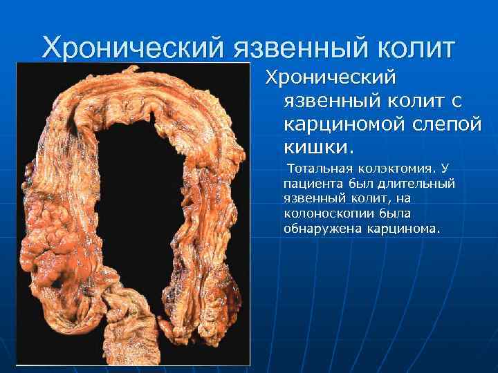 Хронический язвенный колит с карциномой слепой кишки. Тотальная колэктомия. У пациента был длительный язвенный