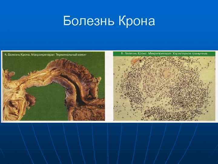 Болезнь Крона 