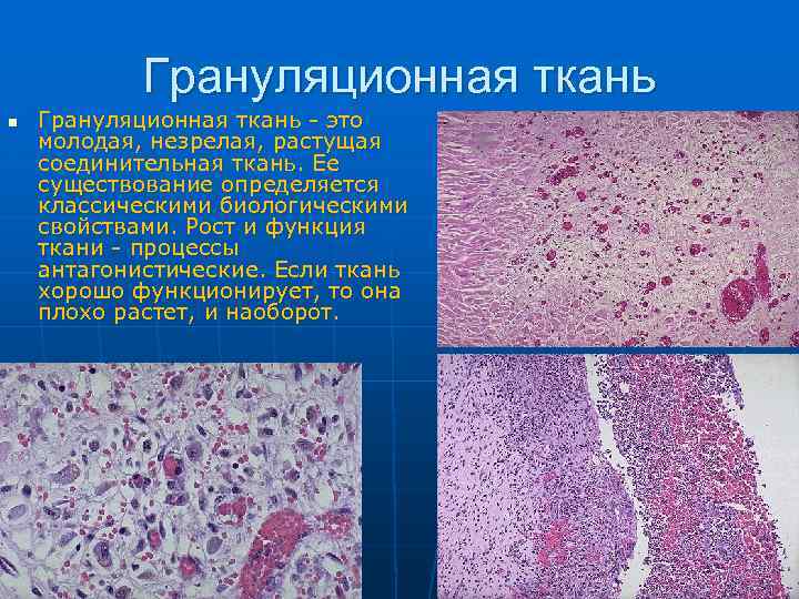 Грануляционная ткань n Грануляционная ткань - это молодая, незрелая, растущая соединительная ткань. Ее существование