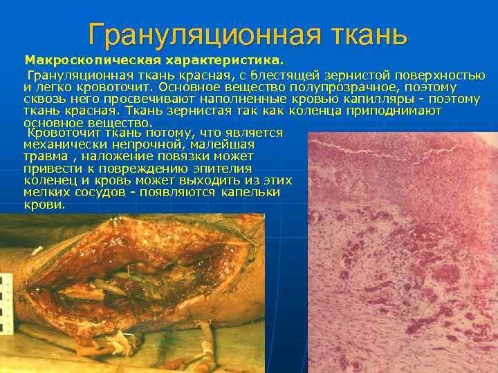 Грануляционная ткань Макроскопическая характеристика. Грануляционная ткань красная, с блестящей зернистой поверхностью и легко кровоточит.
