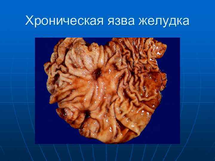 Хроническая язва желудка 