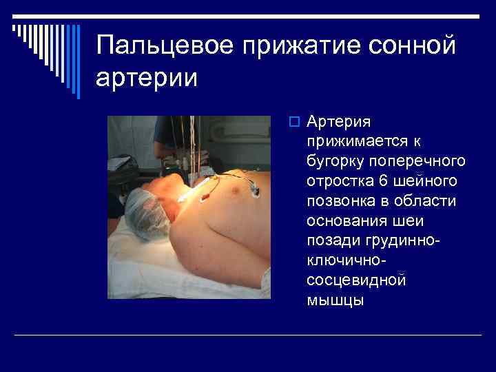 Пальцевое прижатие сонной артерии o Артерия прижимается к бугорку поперечного отростка 6 шейного позвонка