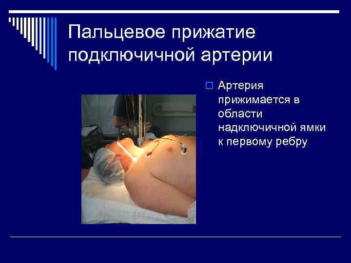 Пальцевое прижатие подключичной артерии o Артерия прижимается в области надключичной ямки к первому ребру