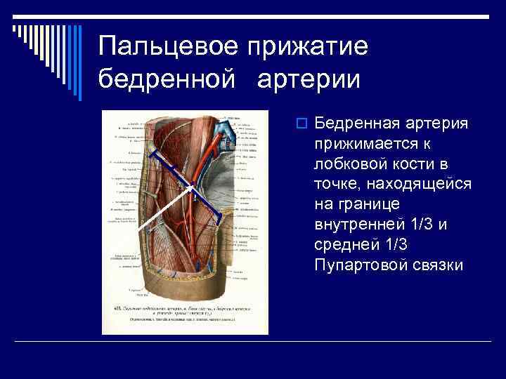 Бедренный разрыв. Кровотечение артерия бедренная артерия. Бедренная артерия анатомия. Пальцевое прижатие бедренной артерии. Сегменты общей бедренной артерии.