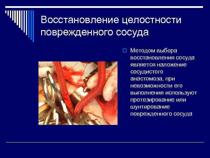 Восстановление целостности поврежденного сосуда o Методом выбора восстановления сосуда является наложение сосудистого анастомоза, при