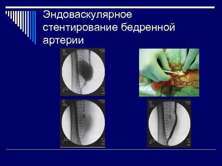 Эндоваскулярное стентирование бедренной артерии 