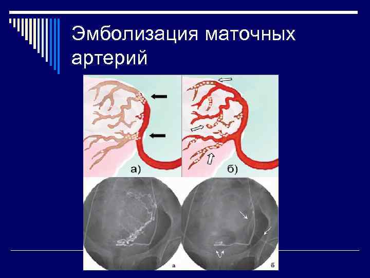 Эмболизация маточных артерий 