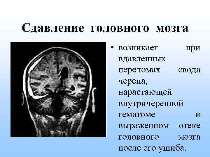 Сдавление мозга признаки. Сдавление головного мозга. Сдавление костей черепа. Сдавление головного мозга при переломе свода черепа.