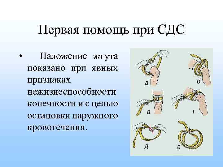 Почему жгут. Наложение жгута при синдроме длительного сдавления. Конечность при наложении жгута. При синдроме длительного сдавления жгут накладывают. Наложение жгута при СДС.