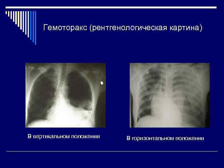 Гемоторакс (рентгенологическая картина) В вертикальном положении В горизонтальном положении 