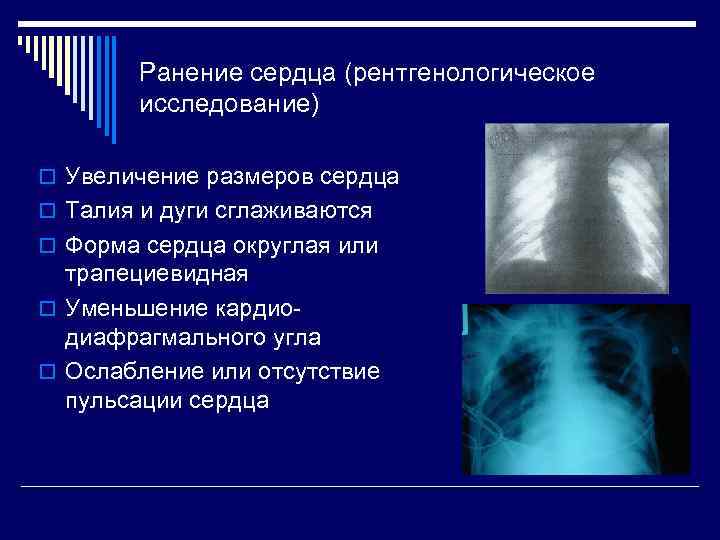Ранение сердца (рентгенологическое исследование) o Увеличение размеров сердца o Талия и дуги сглаживаются o