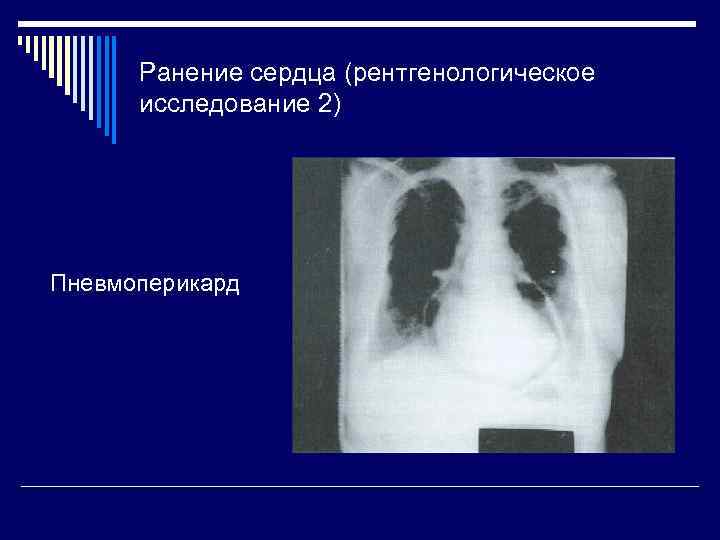 Ранение сердца (рентгенологическое исследование 2) Пневмоперикард 