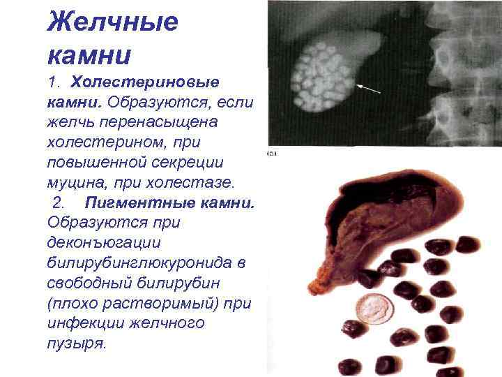 Желчные камни 1. Холестериновые камни. Образуются, если желчь перенасыщена холестерином, при повышенной секреции муцина,