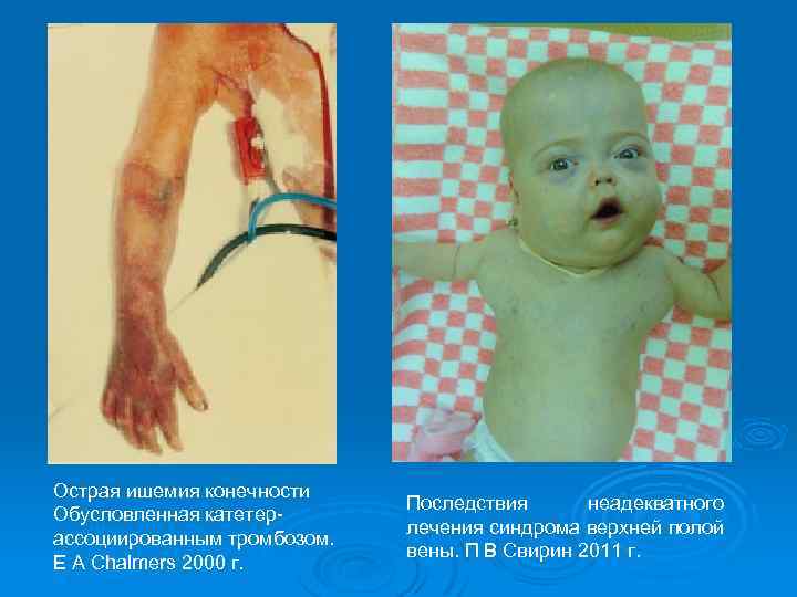 Острая ишемия конечности Обусловленная катетерассоциированным тромбозом. E A Chalmers 2000 г. Последствия неадекватного лечения